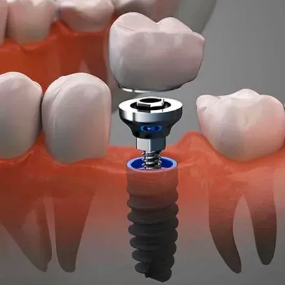 Implante dental con corona