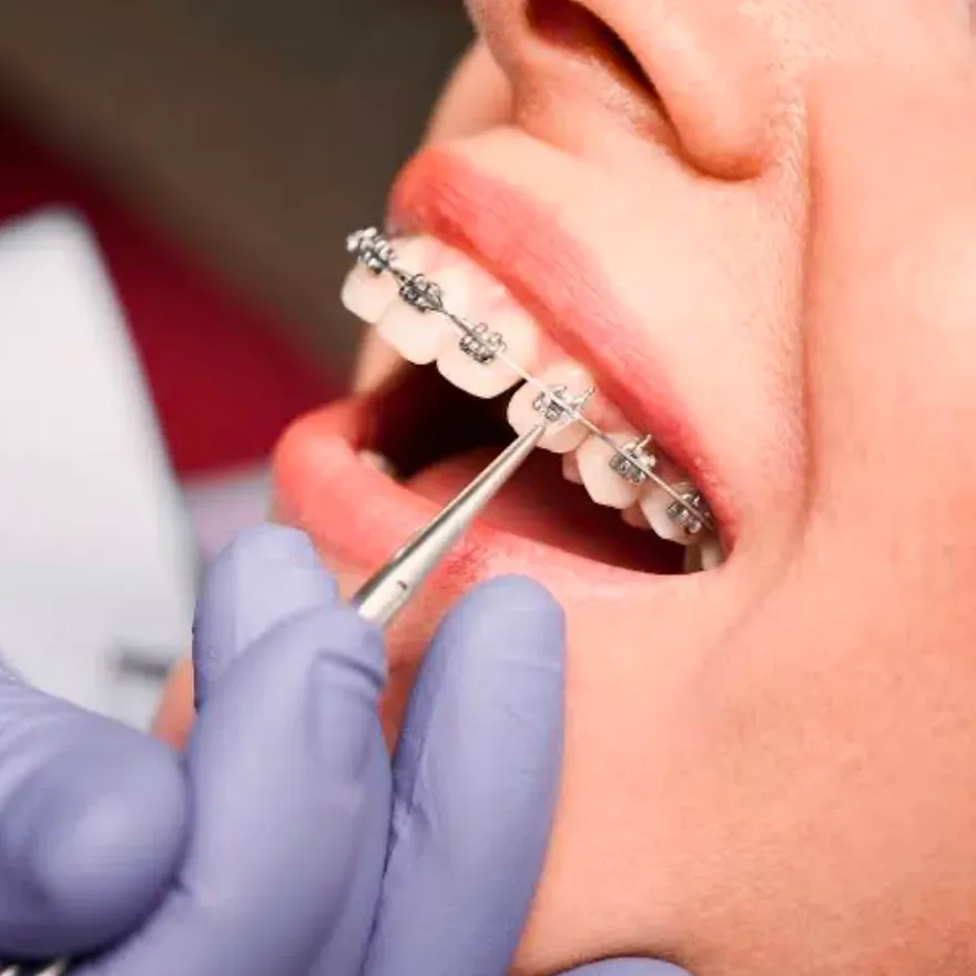 Ajuste de brackets en tratamiento de ortodoncia
